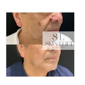 Laser Sunspot Removal at Skin loft New York