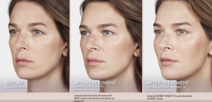 Before and after images showing facial rejuvenation after Juvederm filler injections, with smoother skin and enhanced volume