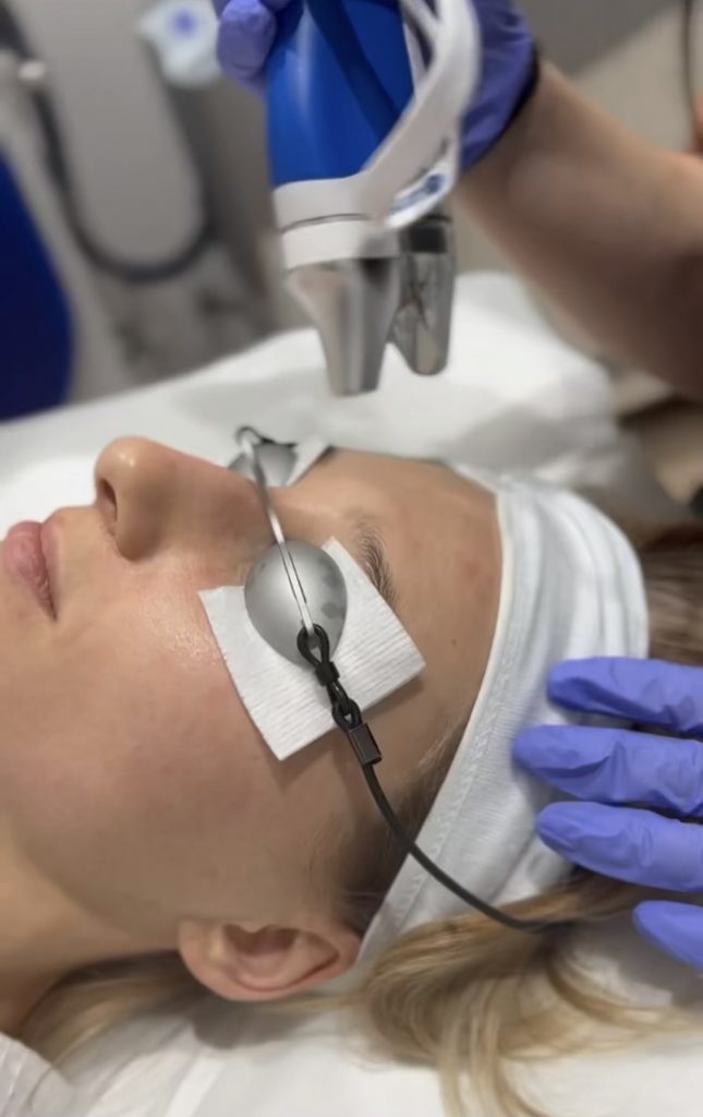 Laser treatment targeting sunspots on a woman’s face with protective eye shields during procedure
