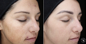 Before and after VI Peel treatment showing reduced acne, pigmentation, and improved skin texture.