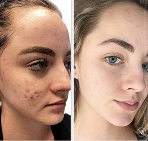 Before and after acne treatment showing clearer skin and reduced blemishes after professional care and VI Peel.