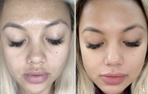 Before and after VI Peel treatment showing improved skin tone, reduced hyperpigmentation, and smoother complexion.