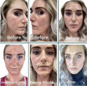 Before and after VI Peel progression showing acne-prone skin, post-treatment peeling phase, and clearer, smoother skin after recovery