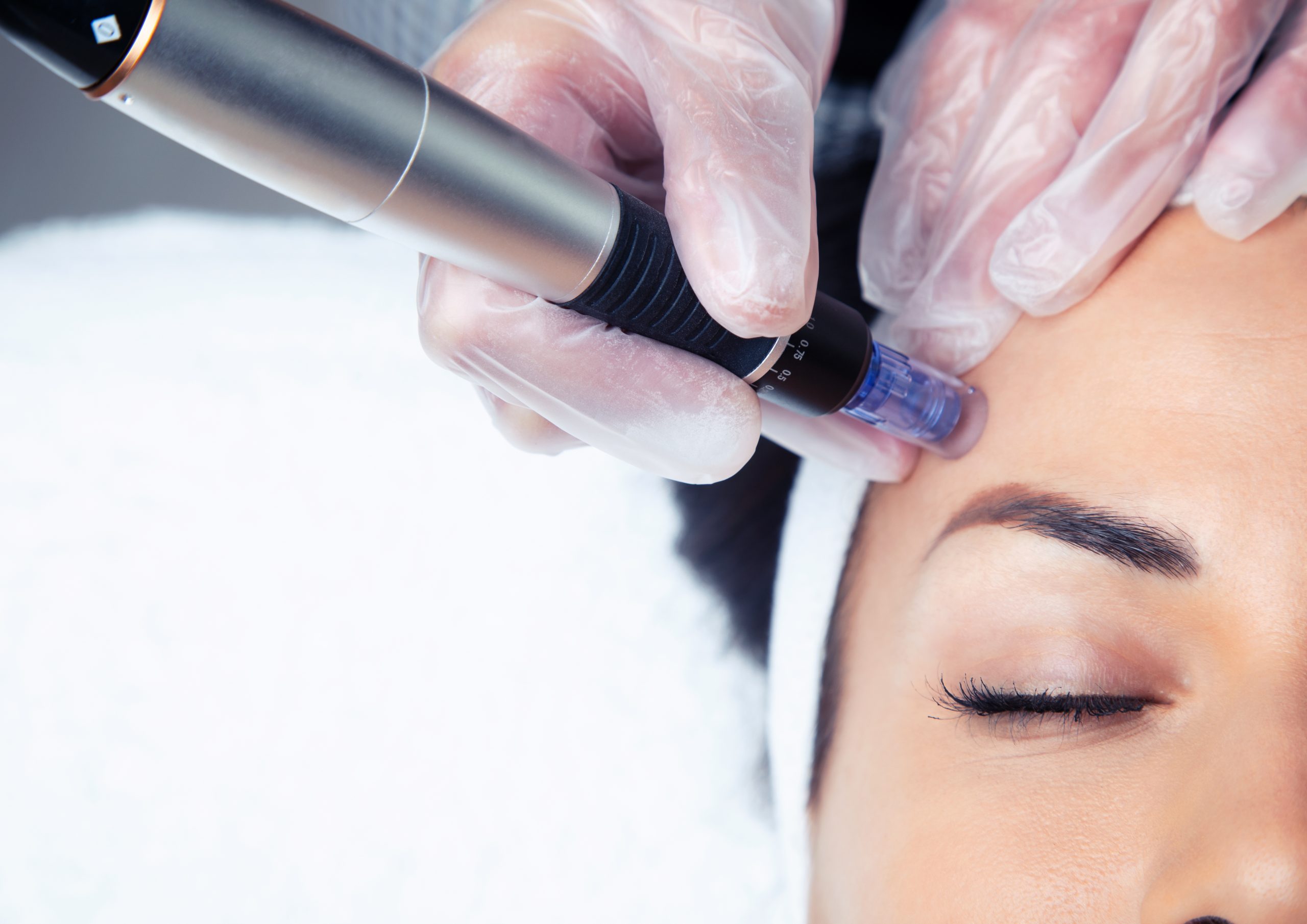 Featured image for “Reasons Microneedling Is So Beneficial for Your Skin￼”