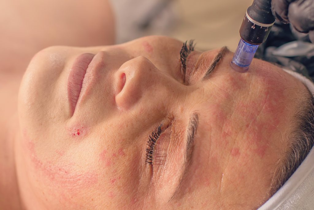 This image has an empty alt attribute; its file name is microneedling-pic-of-woman-1024x683.jpg