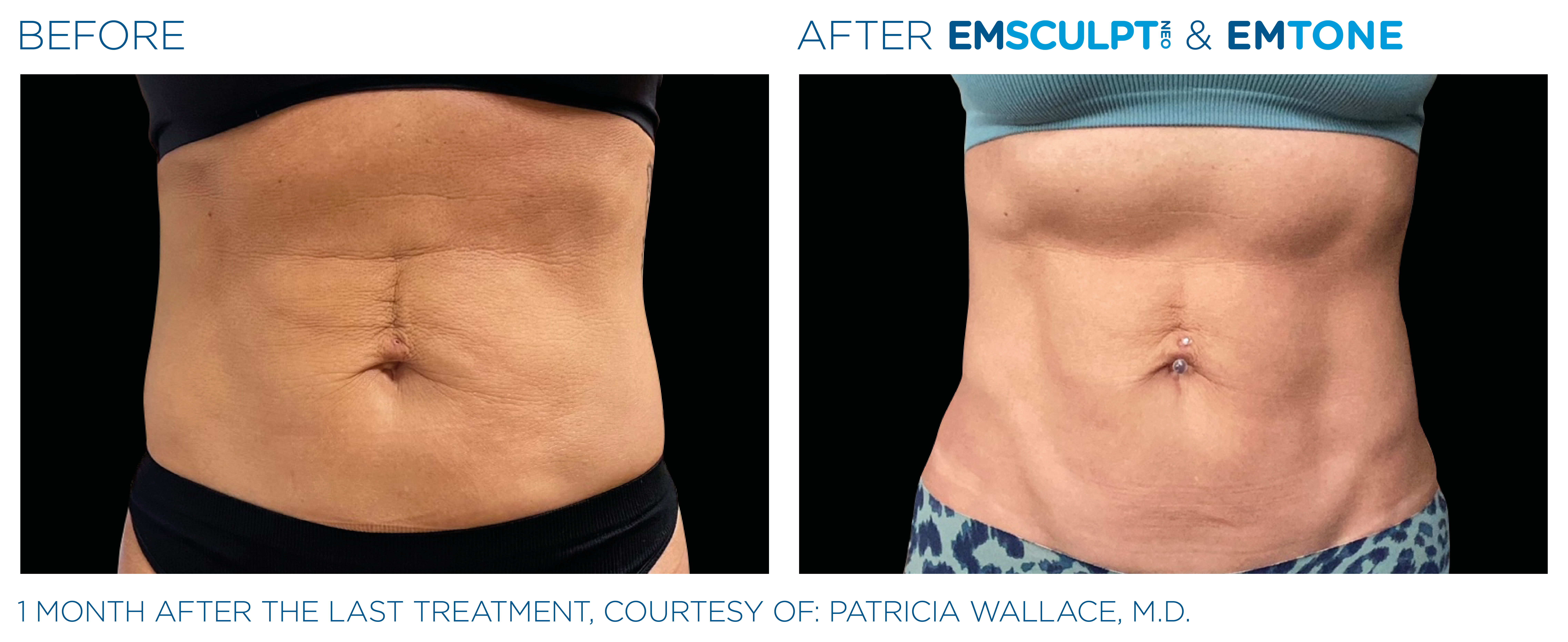 Emsculpt_Neo-Emtone_PIC_Ba-card-female-abdomen