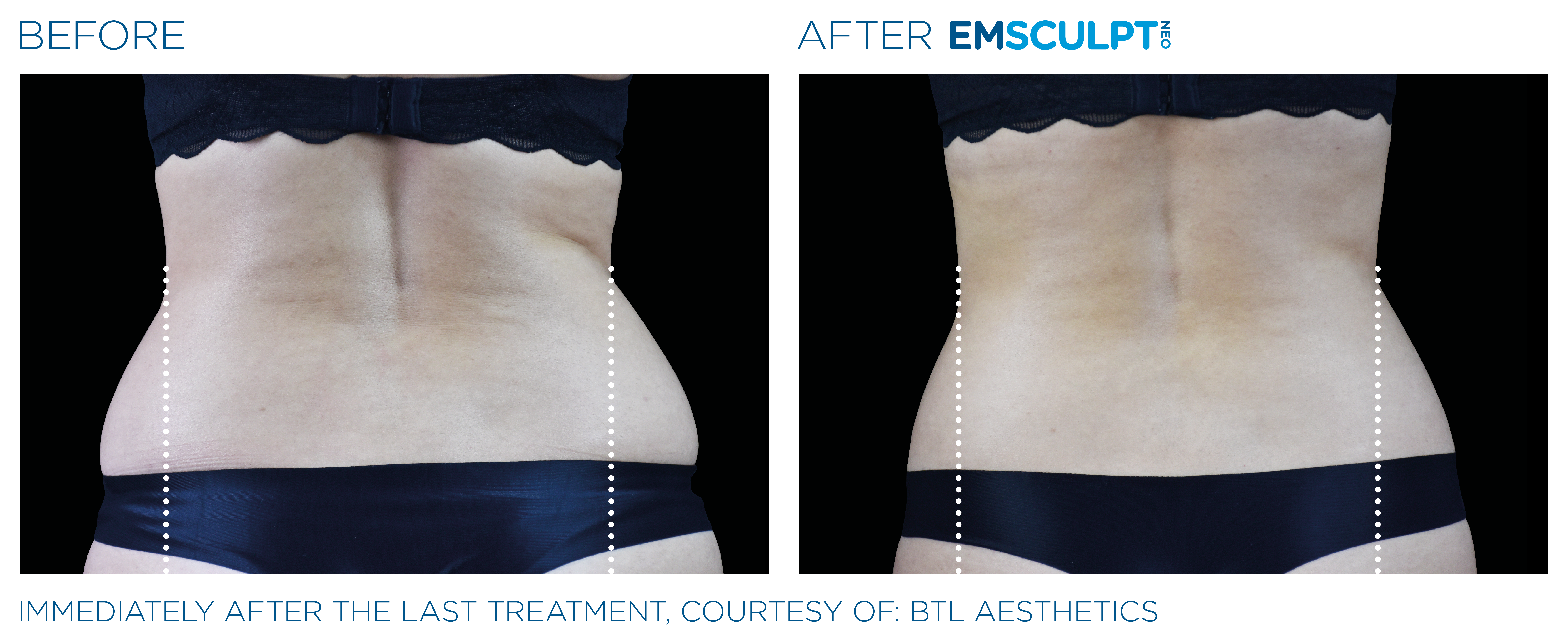 Emsculpt_Neo_PIC_Ba-card-female-lateral-abdomen