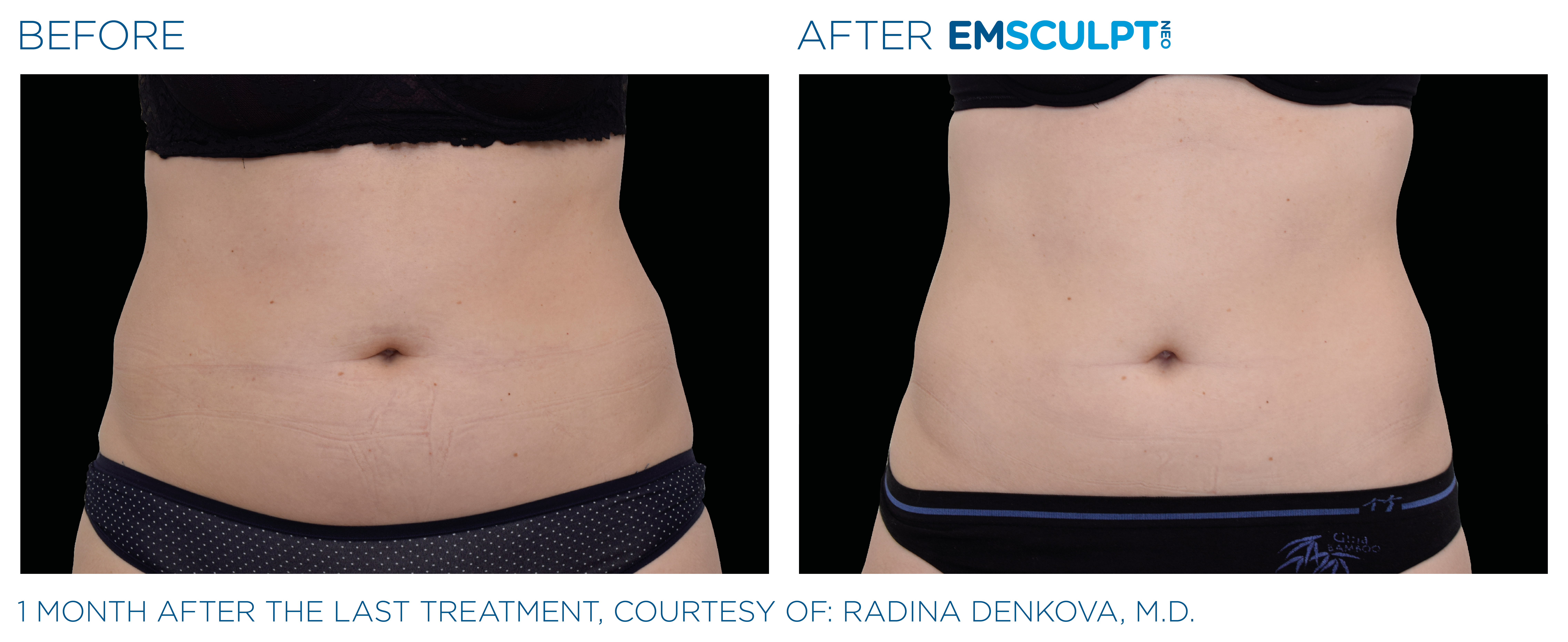 Emsculpt_neo_PIC_Ba-card-female-abdomen-019_ENUS100
