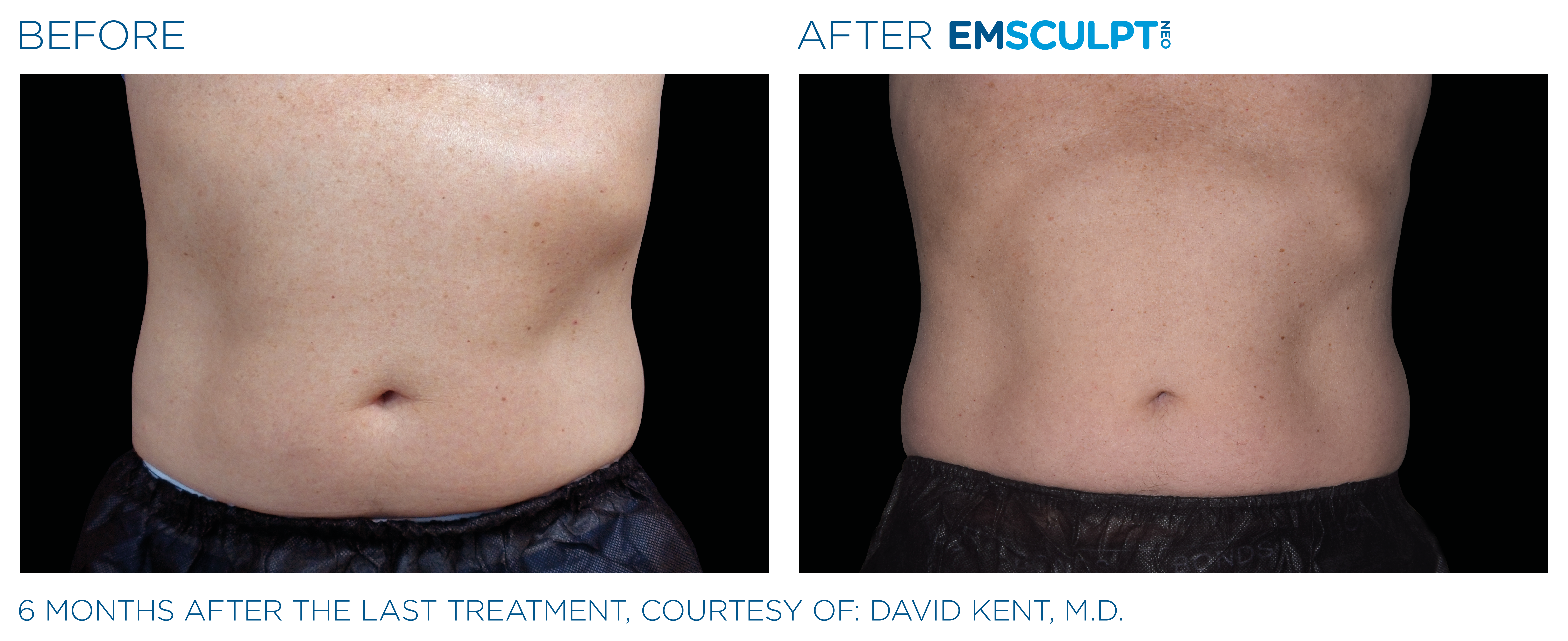 Emsculpt_neo_PIC_Ba-card-male-abdomen