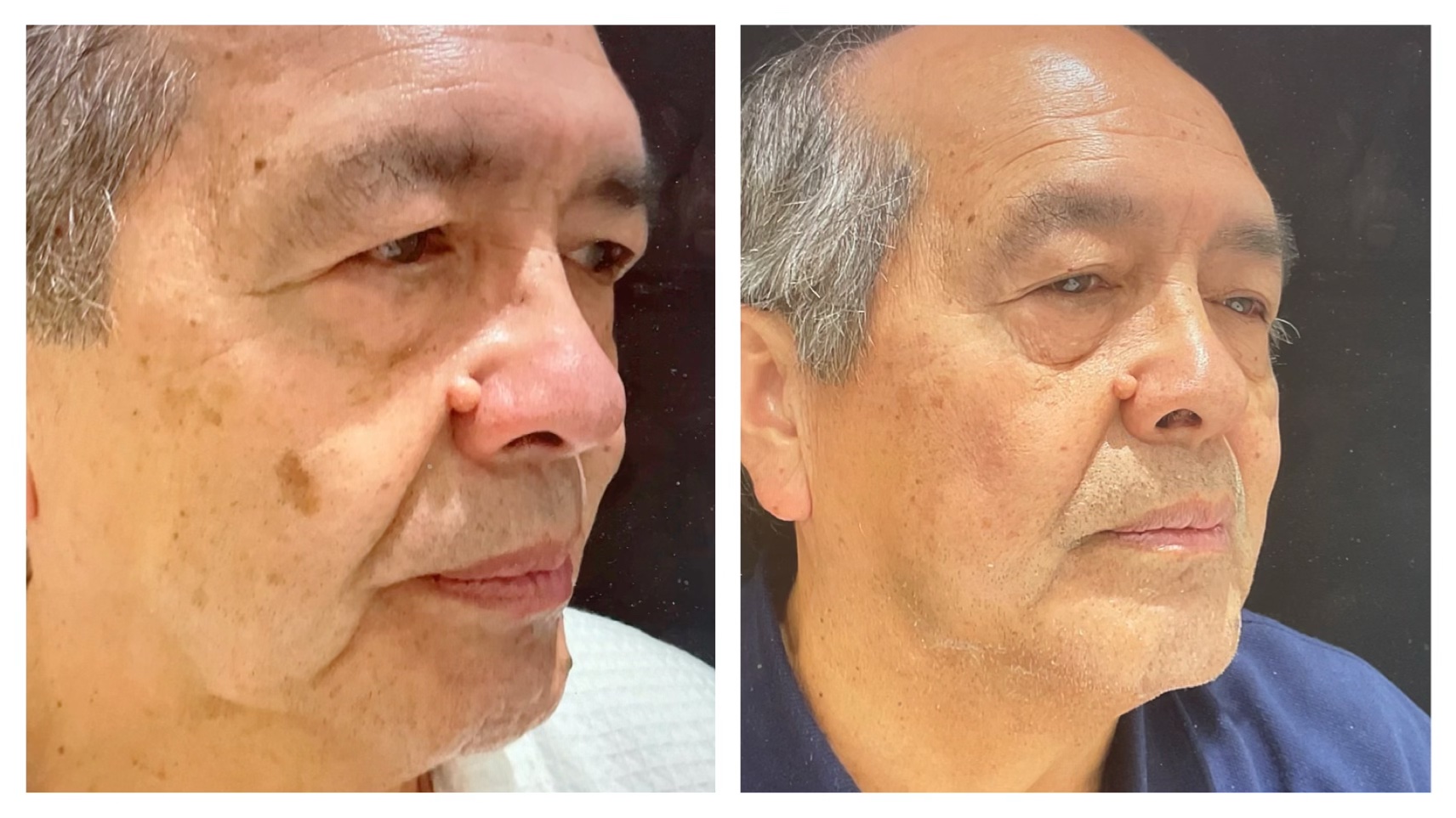 Laser Treatment for the Removal of Dark Spots