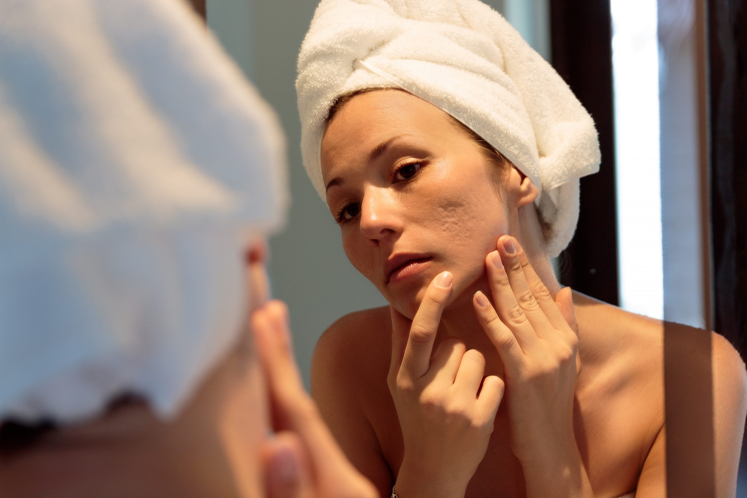 Featured image for “Acne Scars? Here’s How To Get Rid Of Them.”