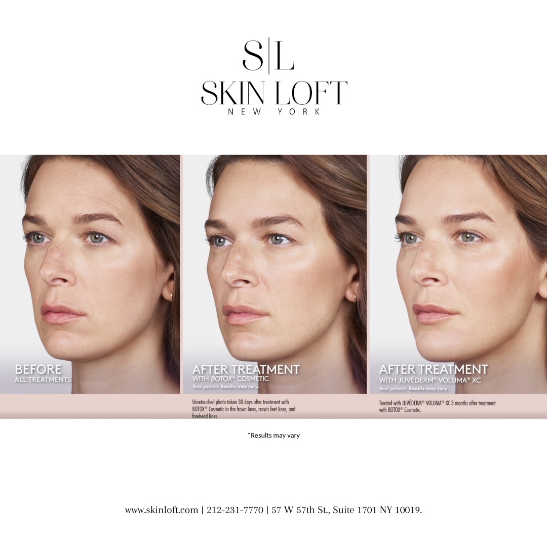 Dermal Fillers