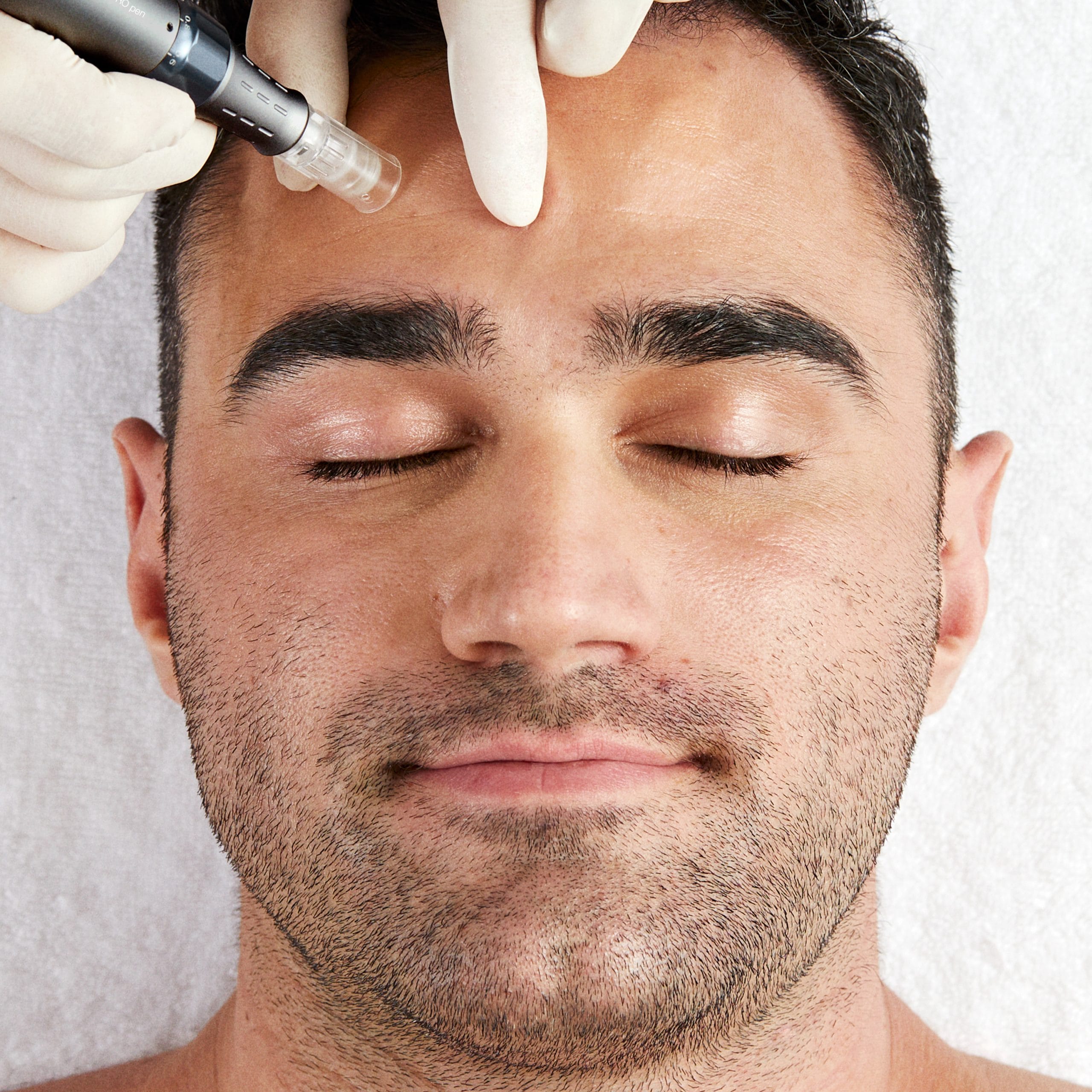 Featured image for “Microneedling”