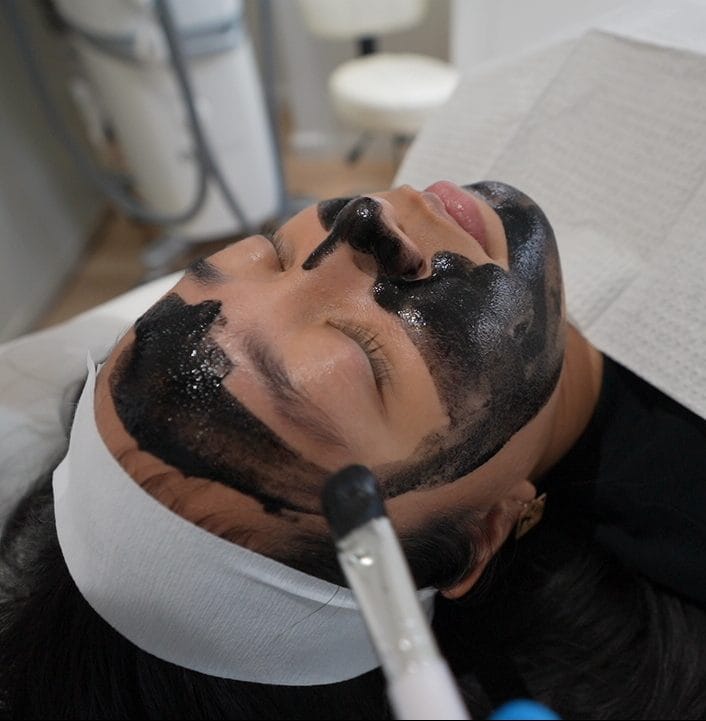 Carbon Laser Facial treatment in progress with a dark carbon mask applied to the client's face at Skin Loft NY