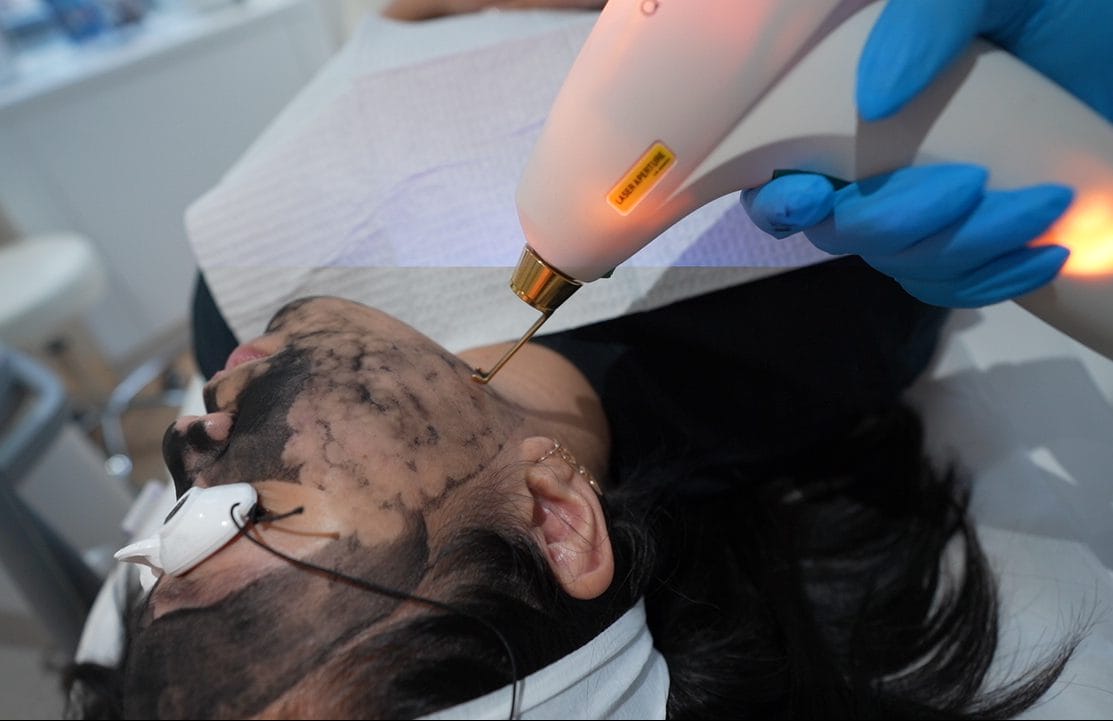 Laser device targeting carbon mask during Carbon Laser Facial at Skin Loft New York