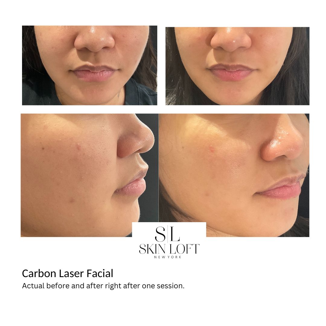 Carbon Laser Facial progress results at Skin Loft New York