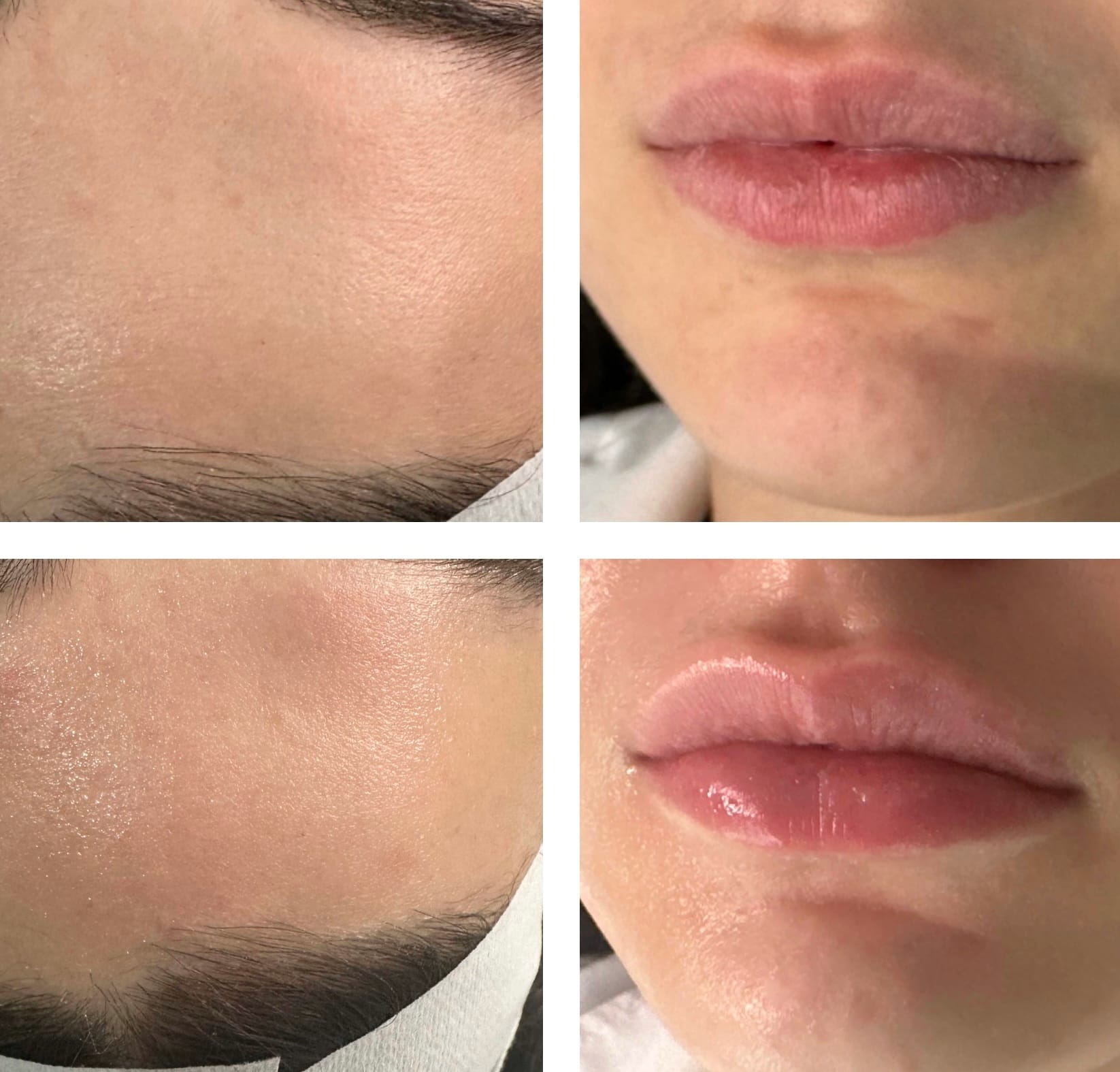 SL Nano Infusion Facial